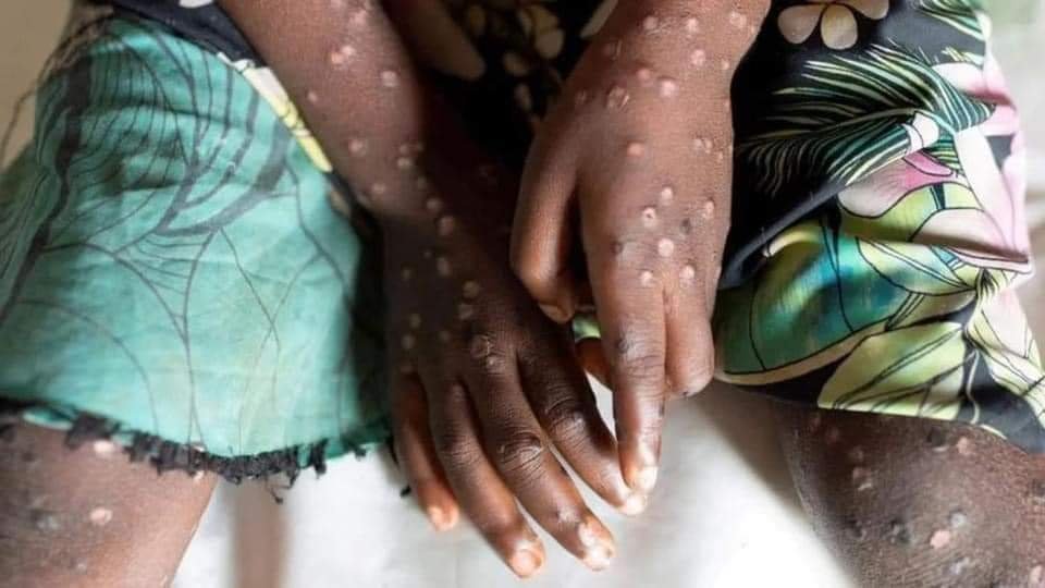 Reporta Primer Caso de Viruela del Mono Fuera de África, es en Suecia.