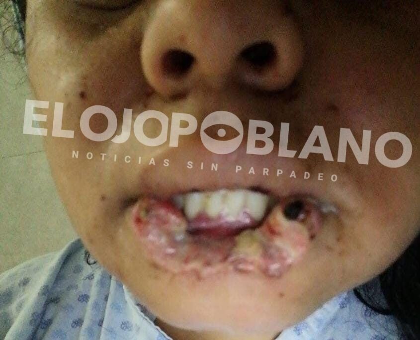 Le arrancó el labio y quiso matarla en Huejotzingo